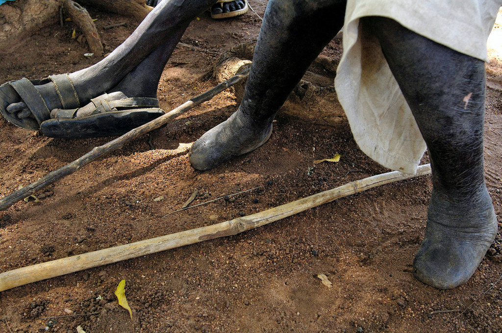 Residents at the Luri-Rokwe leper colony in Sudan in 2008. (file)